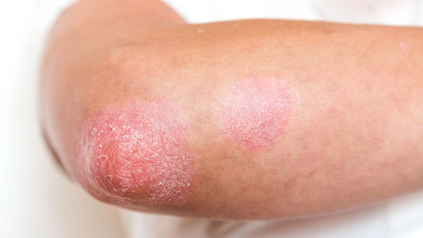 Conclusie: NB-UVB is een effectieve behandeling voor psoriasis - Onderzoek van november 2021